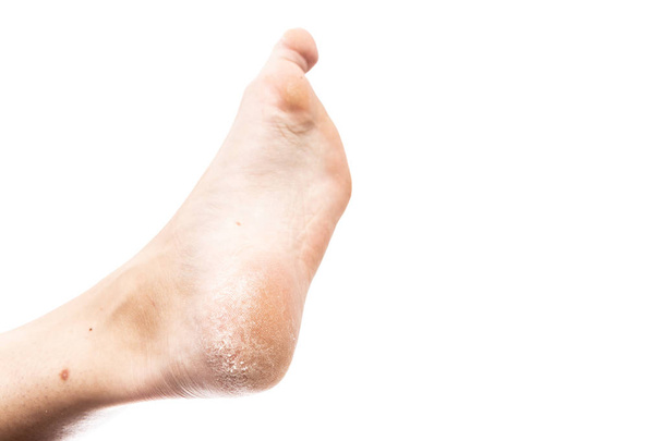 Femme pieds nus avec talon fissuré et les orteils comme concept de problème callus
 - Photo, image