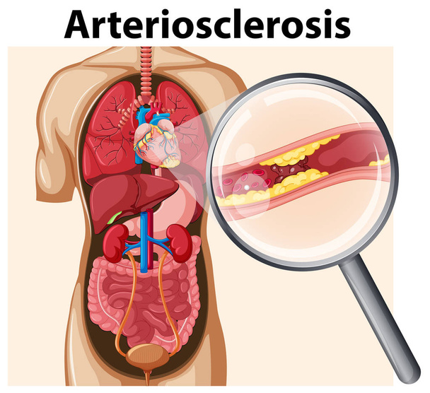 Corpo umano con illustrazione Arteriosclerosi
 - Vettoriali, immagini