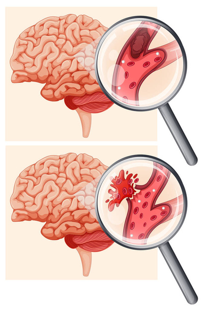 人間の脳と出血性脳卒中の図 - ベクター画像