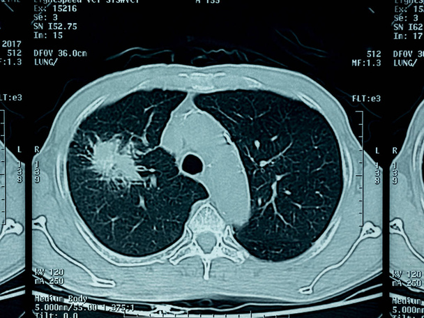 Film x-ışını göğüs, akciğer kanseri duman sigara, sağlık kavramı seven hastadan - Fotoğraf, Görsel