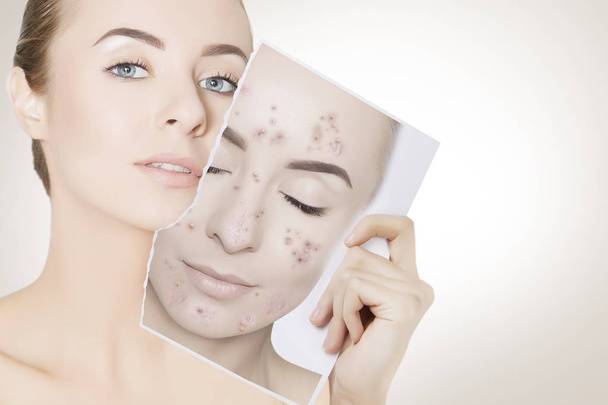 closeup portrait of woman with clean skin holding portrait with pimpled skin - Foto, afbeelding