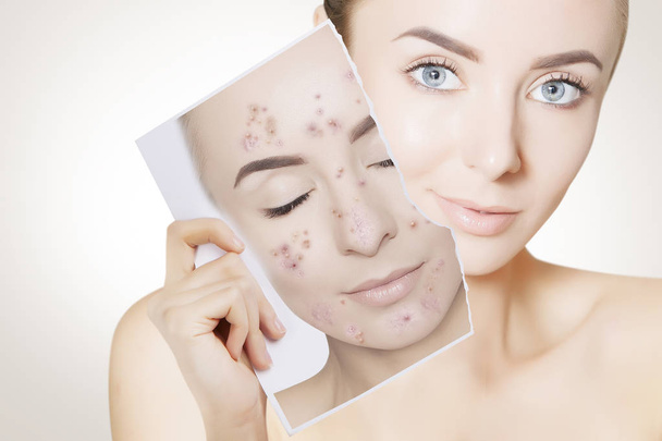 closeup portrait of woman with clean skin holding portrait with pimpled skin - Fotó, kép