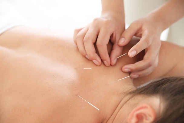 Young woman undergoing acupuncture treatment in salon, closeup - Foto, afbeelding