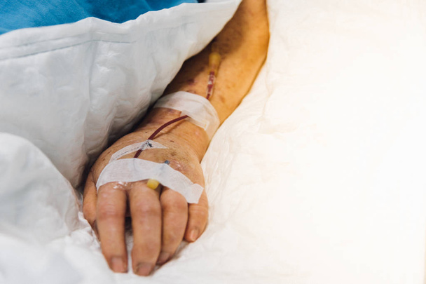 Paciente asiática idosas 80s com solução salina intravenosa em C-line ou A-line em uma mão de paciente idoso no leito do paciente em unidade de terapia intensiva (UTI.) quarto no hospital
. - Foto, Imagem