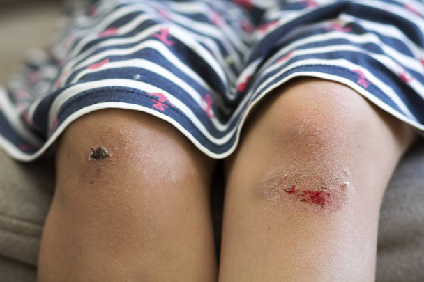 Γκρο πλαν το παιδί κορίτσι μελανιασμένο κατεστραμμένο τραυματισμένα γόνατα μετά από πτώση με παλιές ουλές και φρέσκο αίμα. Τα παιδιά τραύματα, τα ατυχήματα και θεραπεία, προβλήματα της αυξανόμενης-up έννοια. - Φωτογραφία, εικόνα