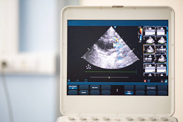 Screen of an ultrasound device with a heart scan. Using the Doppler method, the right ventricular outflow tract is depicted. - Fotografie, Obrázek