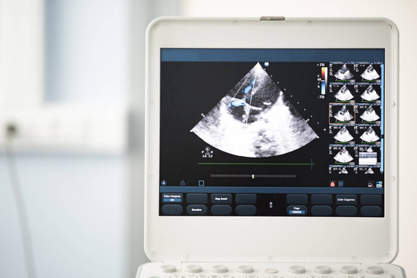 On the ultrasound screen, the image of the heart in the four-chamber position and the Doppler method shows tricuspid regurgitation. - Fotó, kép