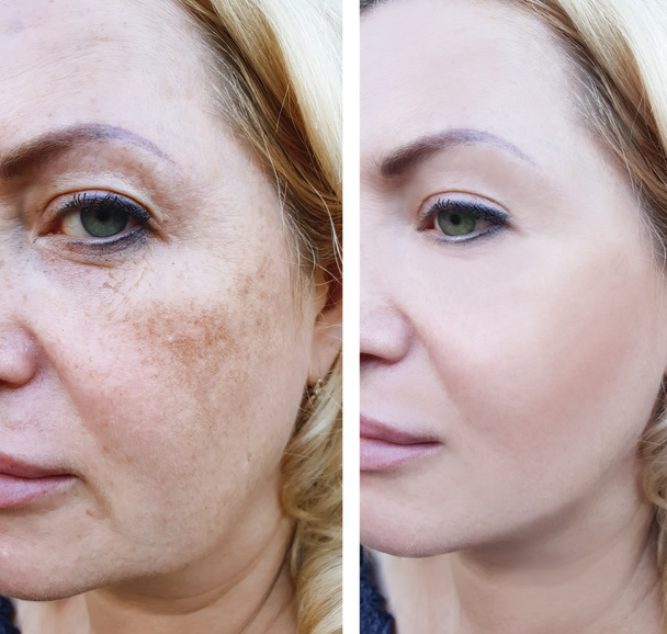 Kız yüz kırışıklıklar öncesi ve sonrası, pigmentasyon - Fotoğraf, Görsel