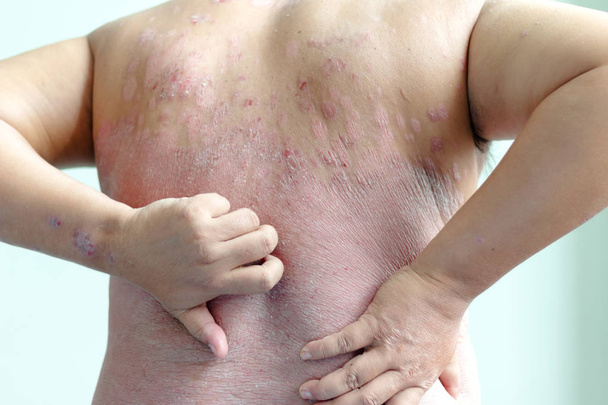 Los pacientes se rascan la espalda, llenos de heridas. Enfermedades causadas por anormalidades de la linfa. La psoriasis es una enfermedad de la piel. Seleccione la profundidad de campo superficial de enfoque y el fondo borroso
 - Foto, imagen