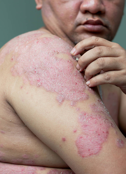 Las personas con psoriasis miran sus brazos llenos de heridas y arañazos. Enfermedades causadas por anormalidades de la linfa. La psoriasis es una enfermedad de la piel. Seleccione la profundidad de campo superficial de enfoque y el fondo borroso
 - Foto, imagen