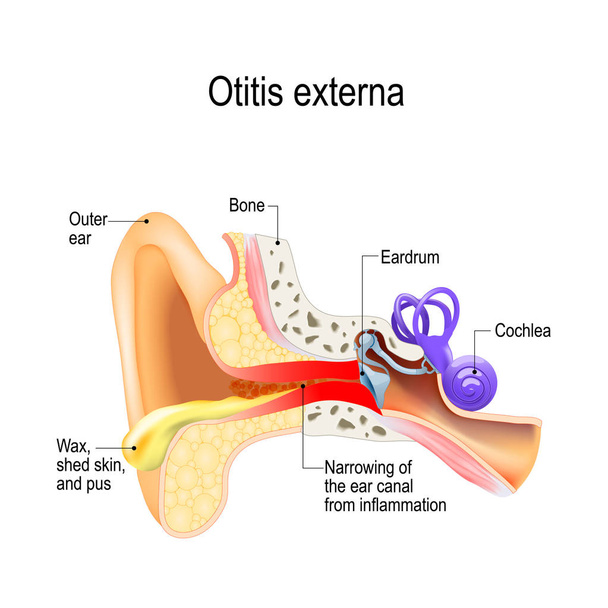 Kulak iltihabı. Otitis externa - Vektör, Görsel