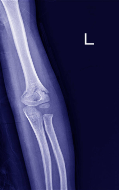 Zlomenina lokte X-ray - Fotografie, Obrázek