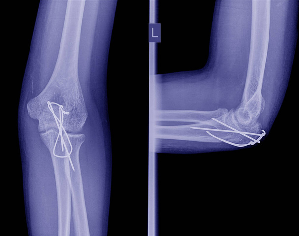 X-ray  post operation internal fixation elbow fracture  - Photo, Image