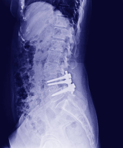 Leğen kemiği ve omurga, yan görünüm sonrası açık redüksiyon Internal fiksasyon ile iç kemik çubuk, plaka ve vida ortopedik cerrah tarafından X-Ray. - Fotoğraf, Görsel