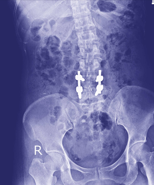 Raio-X da pelve e coluna vertebral, visão lateral Pós-redução aberta Fixação interna com haste óssea interna, placa e parafuso pelo cirurgião ortopédico
. - Foto, Imagem