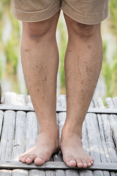 body part: hairy legs young man. stains and birthmarks on the skin.  - Photo, Image