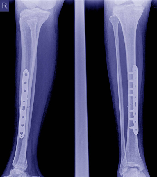 Σπασμένο πόδι ακτινογραφίες εικόνας, x-ray εικόνα του κάταγμα ποδιού (tobia) με εμφύτευμα πλάκα και βίδα. - Φωτογραφία, εικόνα