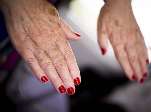 Mãos de uma mulher de meia-idade com problemas de reumatismo, osteoartrite e manchas na pele
 - Foto, Imagem