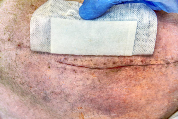 Perna humana velha com cicatriz pós-operatória de cirurgia da articulação do quadril. Detalhe da pele com corte quiúrgico profundo. Serviços de saúde no hospital. Filtro Hipster
.  - Foto, Imagem