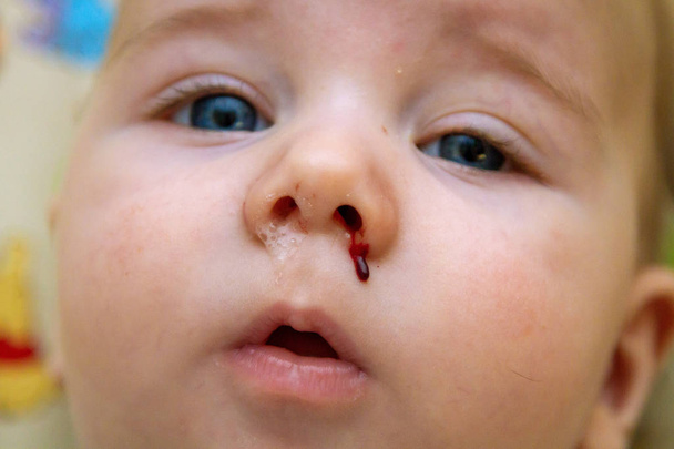 Close-up beeld van de loopneus, bloedige neus van een babyjongen twee dagen na zijn vier maand vaccins. Bijwerkingen van het vaccin Pcv.  - Foto, afbeelding
