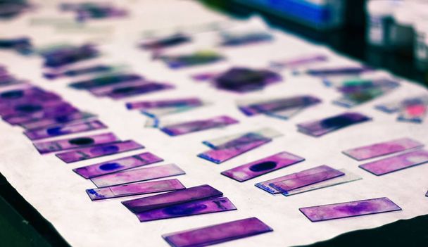 portaobjetos de vidrio manchado de frotis de sangre periférica con mancha de leishman giemsa violeta en el laboratorio de patología hematológica
 - Foto, Imagen