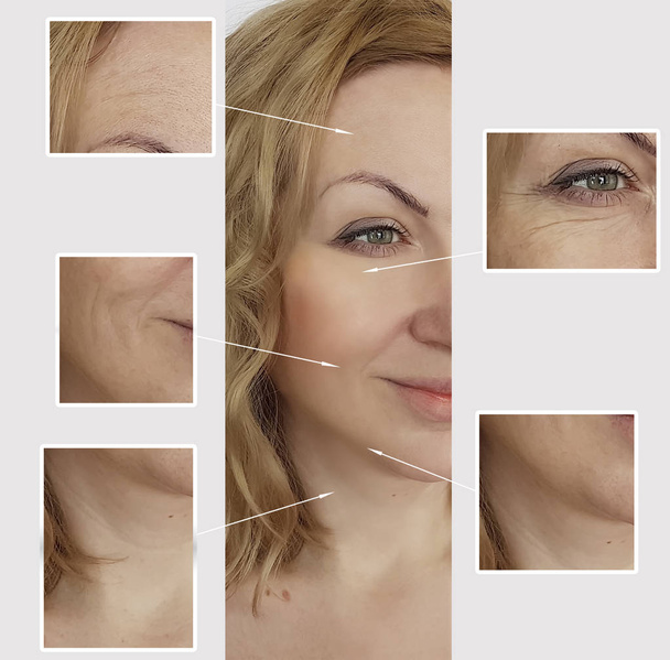 жінка зморшки обличчя до і після процедур
 - Фото, зображення