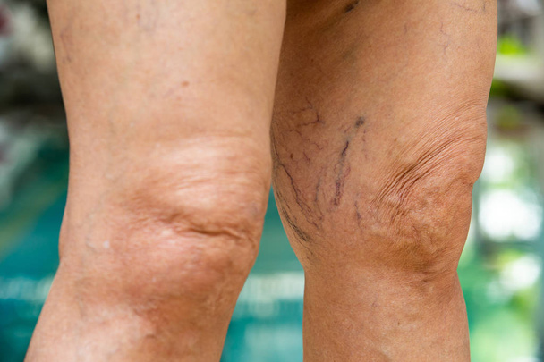 Варикозные вены на коленях и ногах у пожилой женщины
 - Фото, изображение