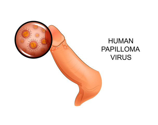 vector illustration of human papilloma virus on penis - Vektör, Görsel