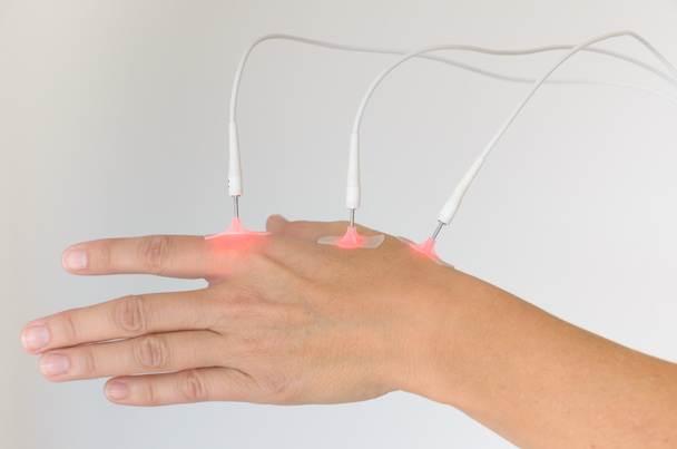 Mujer con EMS o estimulación muscular eléctrica en la mano con electrodos terapéuticos unidos aislados sobre blanco
 - Foto, Imagen