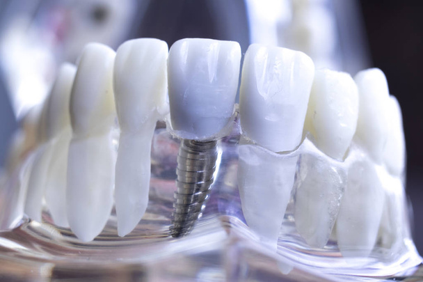 Fogorvos fogászati fogak oktatási modell találat titán fém fog implantátum csavar. - Fotó, kép