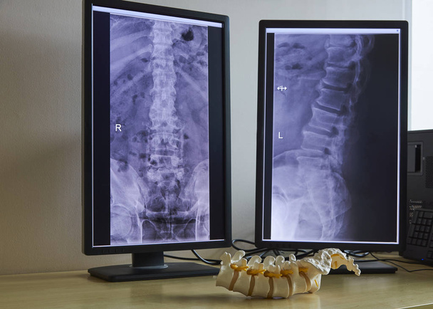 Modelo de columna lumbar humana artificial en consultorio médico. Radiografías de columna lumbar en el monitor del ordenador
. - Foto, Imagen