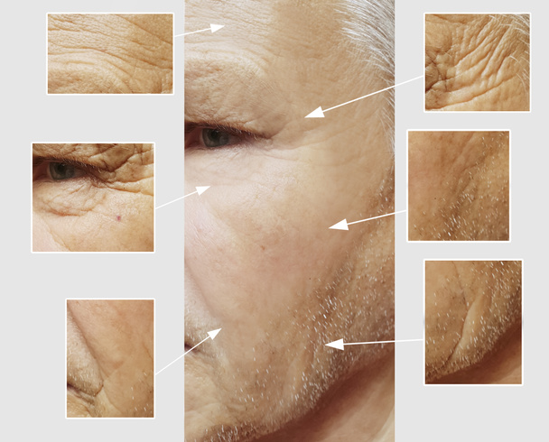 Gesicht eines älteren Mannes Falten im Gesicht vor und nach Eingriffen - Foto, Bild