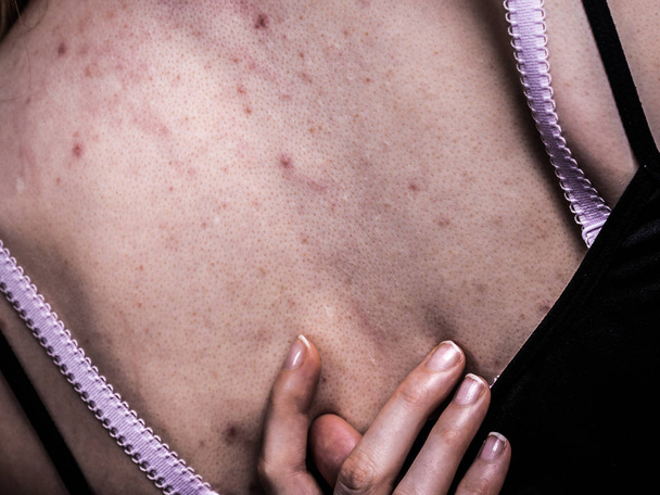 Health problem, skin diseases. Young woman showing her back with acne, red spots. Teen girl scratching her shoulder with pimples. - Φωτογραφία, εικόνα