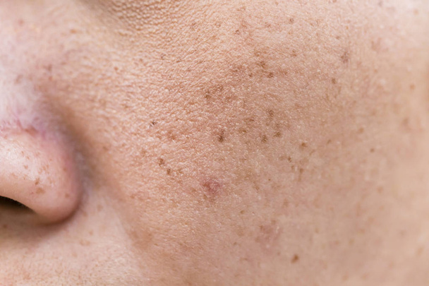 Freckles Over Asian Woman Face, Skin Problems - Photo, Image