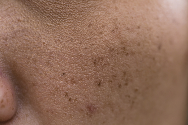 taches de rousseur sur asiatique femme visage, problèmes de peau
 - Photo, image