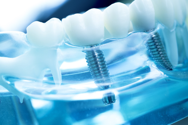 Модель викладання зубів стоматолога, що показує імплантацію імплантату з титанового металу
. - Фото, зображення