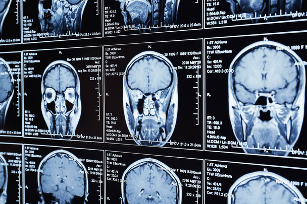 Mágneses rezonancia vizsgálat az agy. Fej MRI-vizsgálat. - Fotó, kép