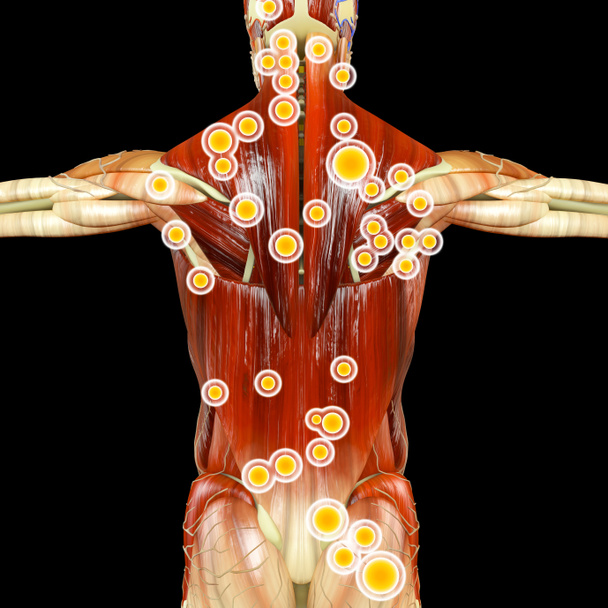 Πίσω όψη ενός άντρα και του σημεία ενεργοποίησης. Ανατομία των μυών. 3D rendering. Myofascial trigger σημεία, περιγράφονται ως hyperirritable σημεία στην περιτονία γύρω στους σκελετικούς μυς. Ψηλαφητή οζίδια σε τεντωμένη μπάντες των μυϊκών ινών. - Φωτογραφία, εικόνα