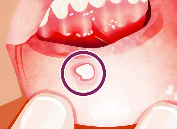 Aftowe zapalenie jamy ustnej to częste schorzenie charakteryzuje się powtarzające się powstawanie łagodnych i nie zaraźliwa owrzodzenia. Owrzodzenia - Zdjęcie, obraz