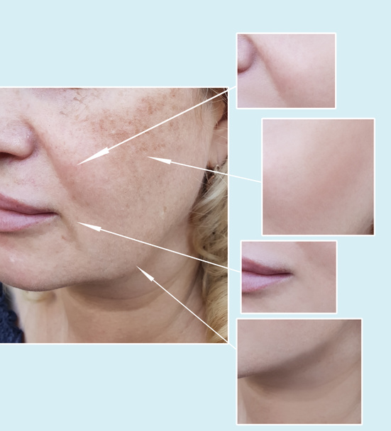 rides du visage de la femme avant et après les procédures, pigmentation
 - Photo, image