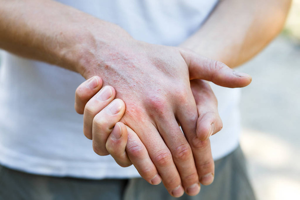 Schuppenflechte vulgaris an den Händen des Mannes mit Belag, Hautausschlag und Flecken auf der Haut. Autoimmunerkrankungen. Nahsicht - Foto, Bild
