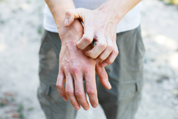 The problem with many people - eczema on hand - Φωτογραφία, εικόνα