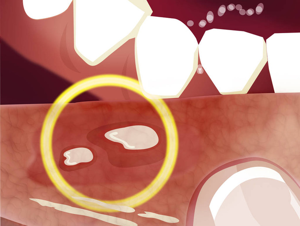 Aftainen stomatiitti on yleinen tila, jolle on ominaista hyvänlaatuisten ja ei-tarttuvien suun haavaumien toistuva muodostuminen. Syöpähaavaumat
 - Valokuva, kuva