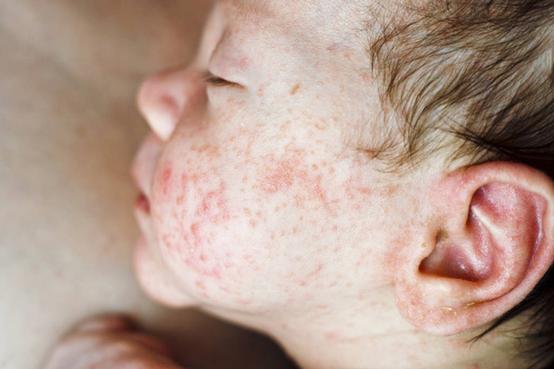 Novorozence baby boy tvář s mnoha červenými pupínky způsobené atopické dermatitidy - Fotografie, Obrázek