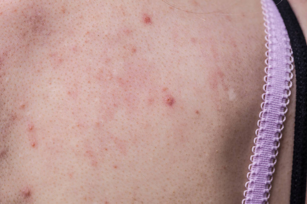 Health problem, skin diseases. Young woman showing her back with allergy rash acne - Foto, imagen