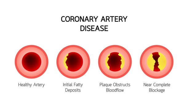 Infografik zur koronaren Herzkrankheit. Herz-Bewusstsein-Konzept. Arteriosklerose Stadien in der Arterie durch Cholesterinbelag verursacht. Vektor-Illustration isoliert auf weißem Hintergrund. - Vektor, Bild