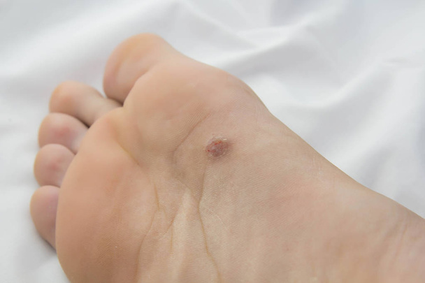 pie con áreas problemáticas en la piel.close up
 - Foto, imagen