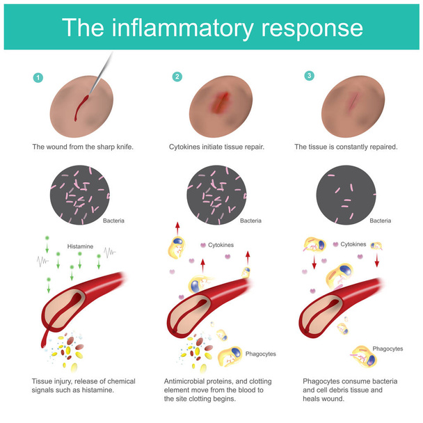 The inflammatory response. When the skin tissue is damaged, the body will produce immunity, eliminate bacteria, together with the new tissue regeneration process. all the response caused by blood vessel and cells fluid in the arteries. - Vector, Image