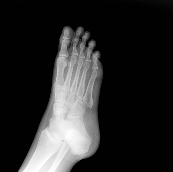 X-ray of the foot, lateral part. pain in the foot. doctor's appointment - Fotografie, Obrázek