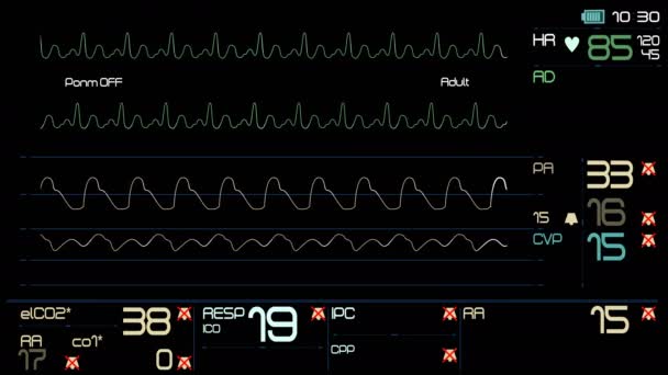 マルチパラ メーター患者モニター画面/医療画面のインターフェイス。測定の st と心臓発作検出やペース メーカー解析と不整脈解析画面で、豊富な機能のすべてを表示.   - 映像、動画